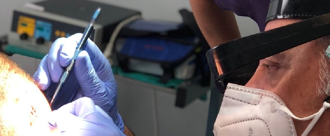 trapianto di capelli con tecnica fue